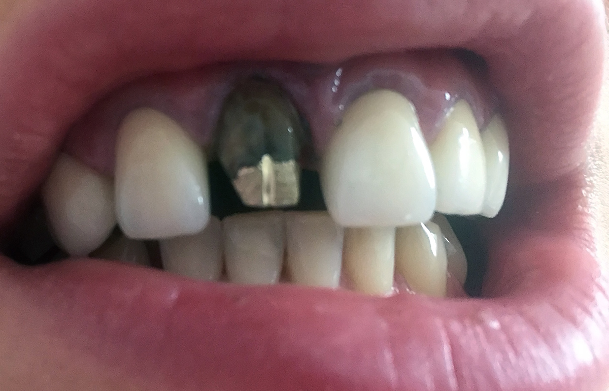 tratament endodontic