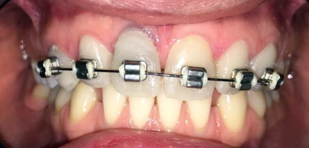 aparat ortodontic